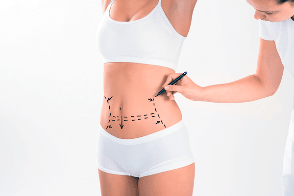 Liposuction Contour Irregularities