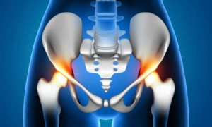 Best Hip Replacement Surgery: Find Your Perfect Surgeon in Ahmedabad