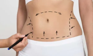 Tummy Tuck in Dubai: What to Expect Before, During, and After the Surgery