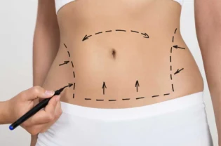 Tummy Tuck in Dubai: What to Expect Before, During, and After the Surgery